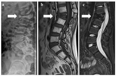 Vertebra Plana: A Narrative Clinical and Imaging Overview among ...