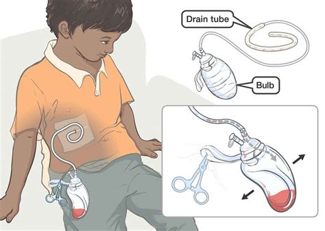 Jackson Pratt Drainage General Surgery Equipments