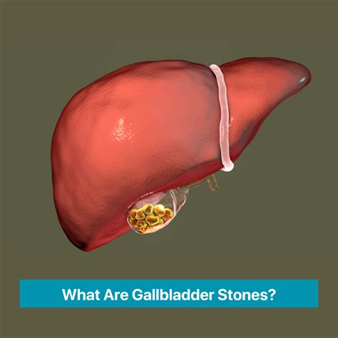 Gallbladder Stones