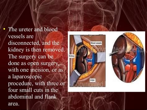 Image result for Nephrectomy Approach