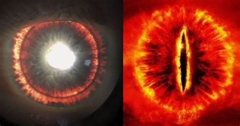 Rare Genetic Disorder Turned This Man's Eye Into A Scary Fireball, Just ...