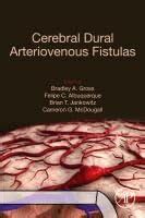 Cerebral Dural Arteriovenous Fistulas: Features, Mechanisms, and ...