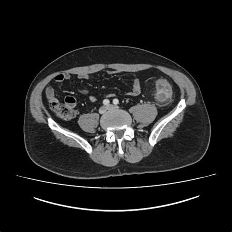 Image result for Colonic Diverticulum CT