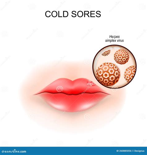 Cold Sores Outbreak Of Herpes HSV On Lips Vector Illustration ...