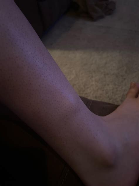 What is this lump on my leg? : r/DermatologyQuestions