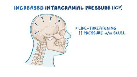 What Is Intracranial Pressure (Icp) at Natosha Guerro blog