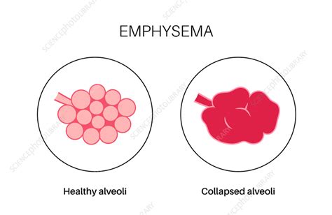 Image result for Emphysema Example