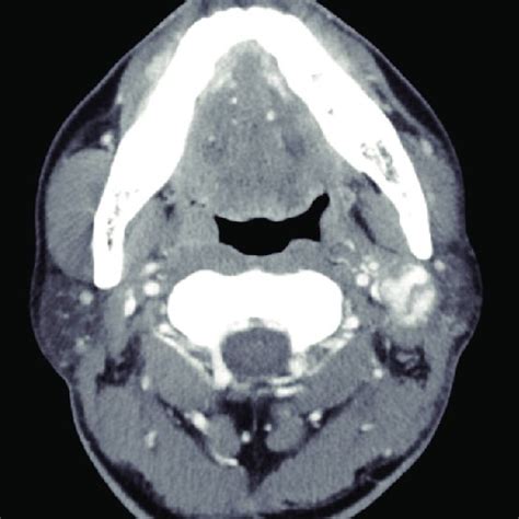 Image result for Nephrectomy Positioning