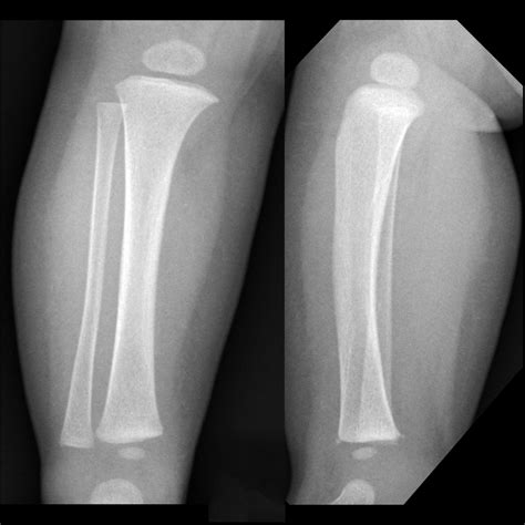 Bucket Handle Fracture