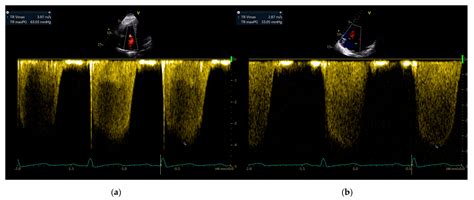 An Exaggerated Rise in Pulmonary Artery Pressure in a High-Altitude ...