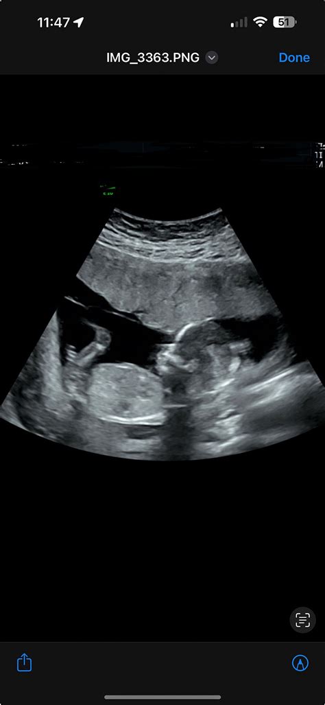 15 week ultrasound | BabyCenter
