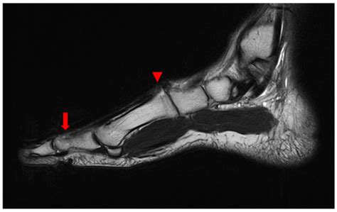 A Neglected Extensor Hallucis Longus Tendon Rupture Caused by Arthritic ...