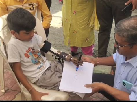 15 were fitted with free prosthetic hands | 15ને નિઃશુલ્ક પ્રોસ્થેટિક ...