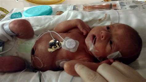 Micro Preemie-born at 31 weeks