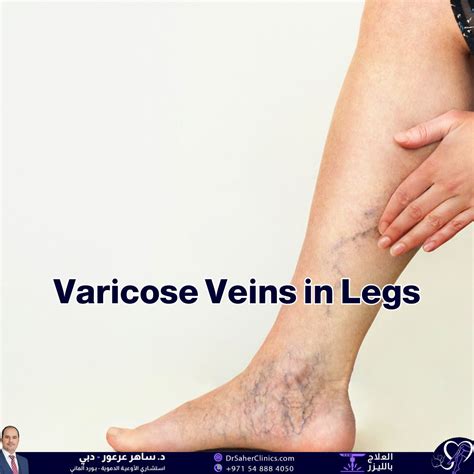 The Impact of Varicose Veins on Health