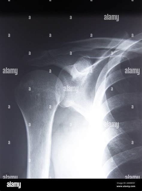 Film X-ray shoulder radiograph show degenerative osteoarthritis disease ...