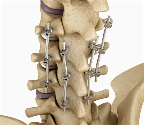 Neck Disk Fusion Surgery at Milly Hicks blog
