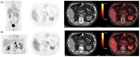 Detection of Liver Lesions in Colorectal Cancer Patients Using 18F-FDG ...