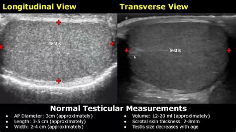 Image result for Transillumination Test Testis