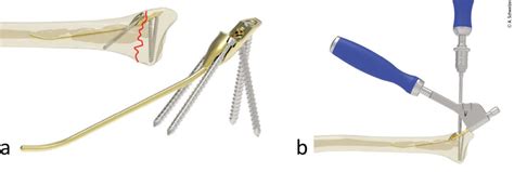 Intramedulläre Nagelung der distalen Radiusfraktur - Orthopädie ...