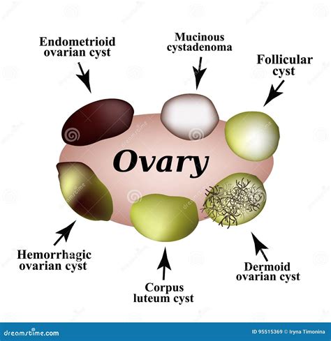 Types of Ovarian Cysts. Set. Infographics. Vector Illustration on Isolated Background. Stock ...