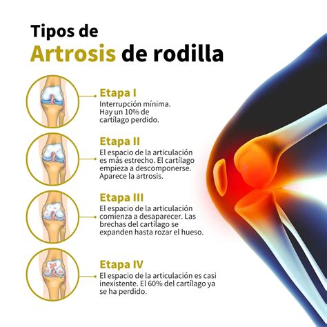 Artrosis de rodilla: Síntomas, tratamientos y prevención | Traumadrid