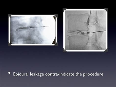 Image result for Disco Injection