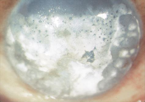 Corneal Deposits - Clinical Tree