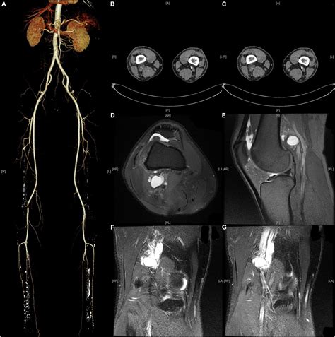 Frontiers | Compression syndromes of the popliteal artery due to ...