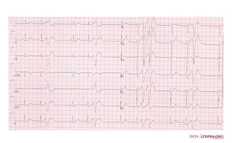 Torsades de pointes ekg examples - wikidoc