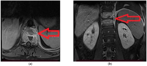 Post-COVID-19 Spondylodiscitis: A Case Study and Review of the Literature