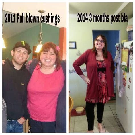 Top 105+ Pictures Cushing's Syndrome Cushing's Disease Before And After Photos Latest