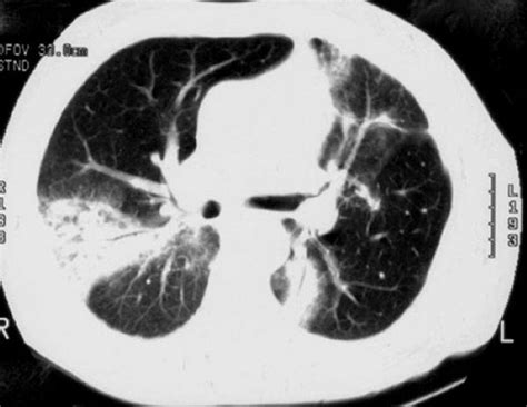 Cryptogenic Organizing Pneumonia (COP) - Pulmonary Disorders - Merck ...