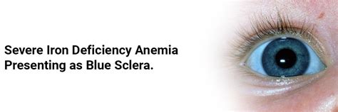 Severe Iron Deficiency Anemia presenting as Blue Sclera.