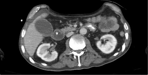Adult Scaphoid Abdomen - The American Journal of Medicine