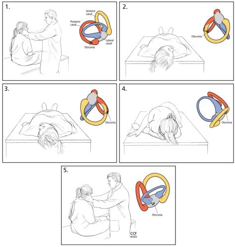 Benign Paroxysmal Positional Vertigo (BPPV): What You Need To Know Right Now - The Vertigo Doctor