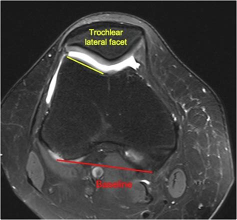 Patellar Tilt and Patellar Tendon–Trochlear Groove Angle Present the Optimum Magnetic Resonance ...