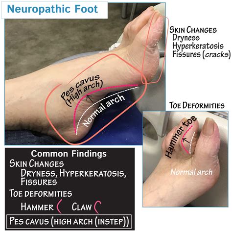 Neuroanatomy Glossary: Pes Cavus (aka High Arch) Foot | ditki medical ...