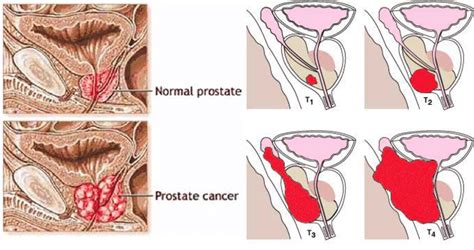 Image result for Normal Prostate Levels