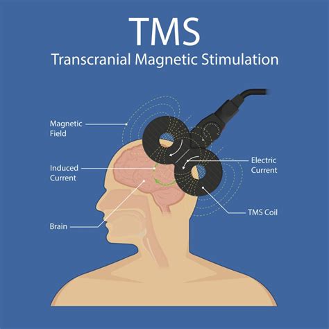 TMS Therapy And Treatment: Pros & Cons - HealingMaps