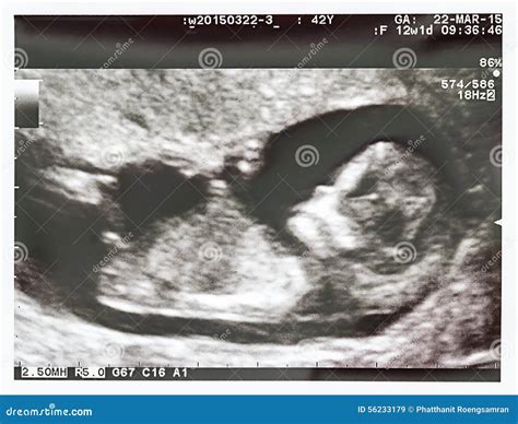 Ultrasound Fetus at 12 Weeks. Stock Image - Image of pregnancy, head: 56233179
