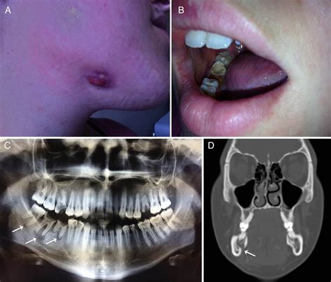 Jaw Osteomyelitis Infection at JENENGE blog