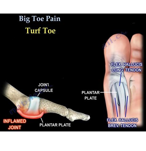Big Toe Pain – Everything You Need To Know — OrthopaedicPrinciples.com