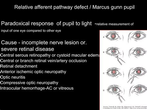 Pupillary pathway and its abnormality. | PPTX
