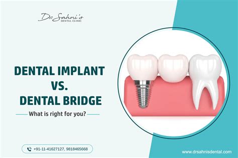 Dental Implant Clinic in South Delhi | Best Dental Clinic, Best Dentist in South Delhi | Sahni ...