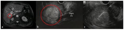 Endoscopic Ultrasound-Guided Fine Needle Biopsy of Focal Liver Lesions ...