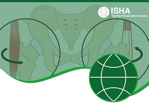 Snapping Hip Syndrome