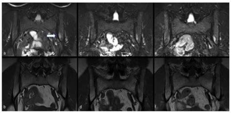 Post-COVID-19 Arthritis and Sacroiliitis: Natural History with ...
