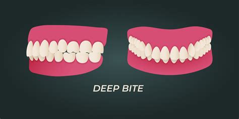 Deep Bite Vs Overbite