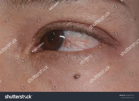 Close Conjunctival Cyst During Eye Examination Stock Photo 1059877751 | Shutterstock